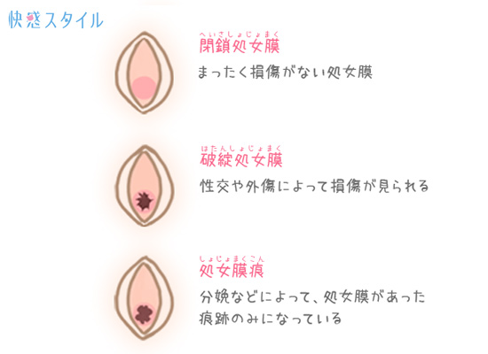 損傷によって分類される処女膜のイラスト